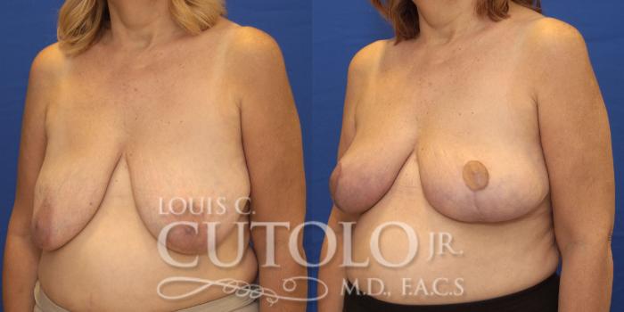Before & After Breast Lift Case 158 View #2 View in Brooklyn, Staten Island, Queens, NY