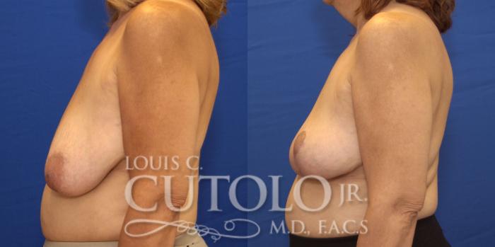 Before & After Breast Lift Case 158 View #3 View in Brooklyn, Staten Island, Queens, NY