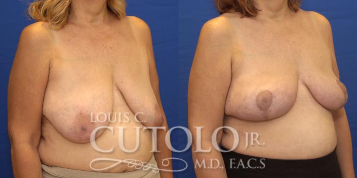 Before & After Breast Lift Case 158 View #4 View in Brooklyn, Staten Island, Queens, NY