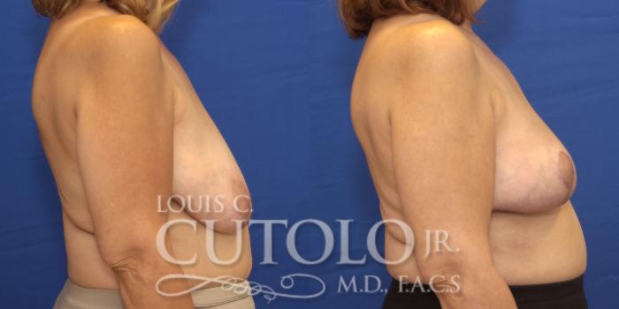 Before & After Breast Lift Case 158 View #5 View in Brooklyn, Staten Island, Queens, NY
