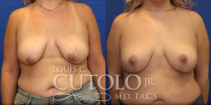 Before & After Breast Lift Case 183 View #1 View in Brooklyn, Staten Island, Queens, NY