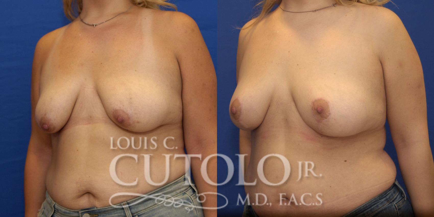 Before & After Breast Lift Case 183 View #2 View in Brooklyn, Staten Island, Queens, NY