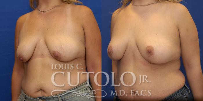 Before & After Breast Lift Case 183 View #2 View in Brooklyn, Staten Island, Queens, NY