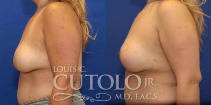 Before & After Breast Lift Case 183 View #3 View in Brooklyn, Staten Island, Queens, NY
