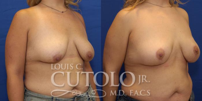Before & After Breast Lift Case 183 View #4 View in Brooklyn, Staten Island, Queens, NY