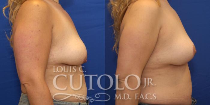 Before & After Breast Lift Case 183 View #5 View in Brooklyn, Staten Island, Queens, NY