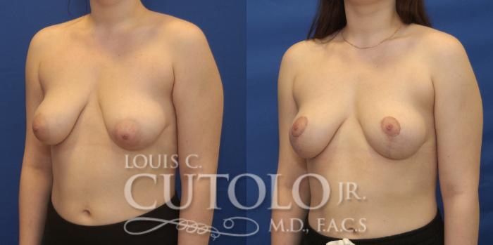Before & After Breast Lift Case 219 View #2 View in Brooklyn, Staten Island, Queens, NY