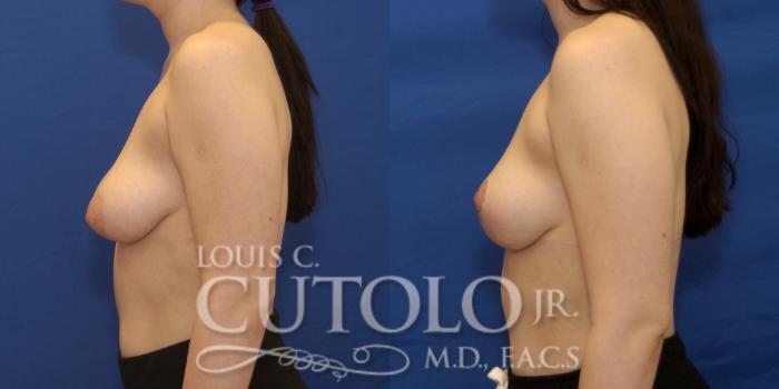 Before & After Breast Lift Case 219 View #3 View in Brooklyn, Staten Island, Queens, NY
