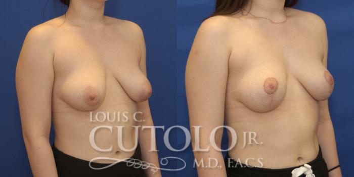Before & After Breast Lift Case 219 View #4 View in Brooklyn, Staten Island, Queens, NY