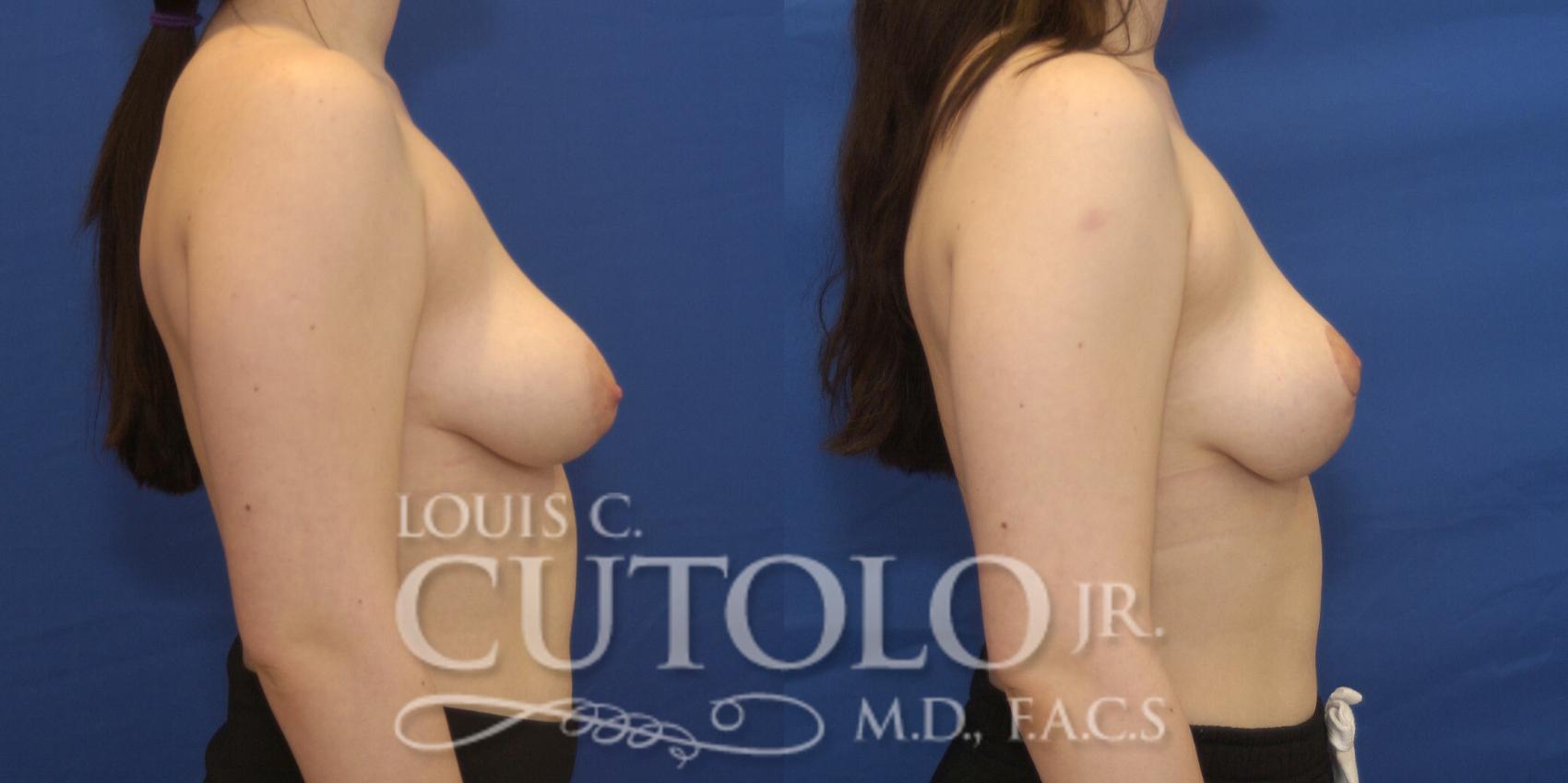 Before & After Breast Lift Case 219 View #5 View in Brooklyn, Staten Island, Queens, NY