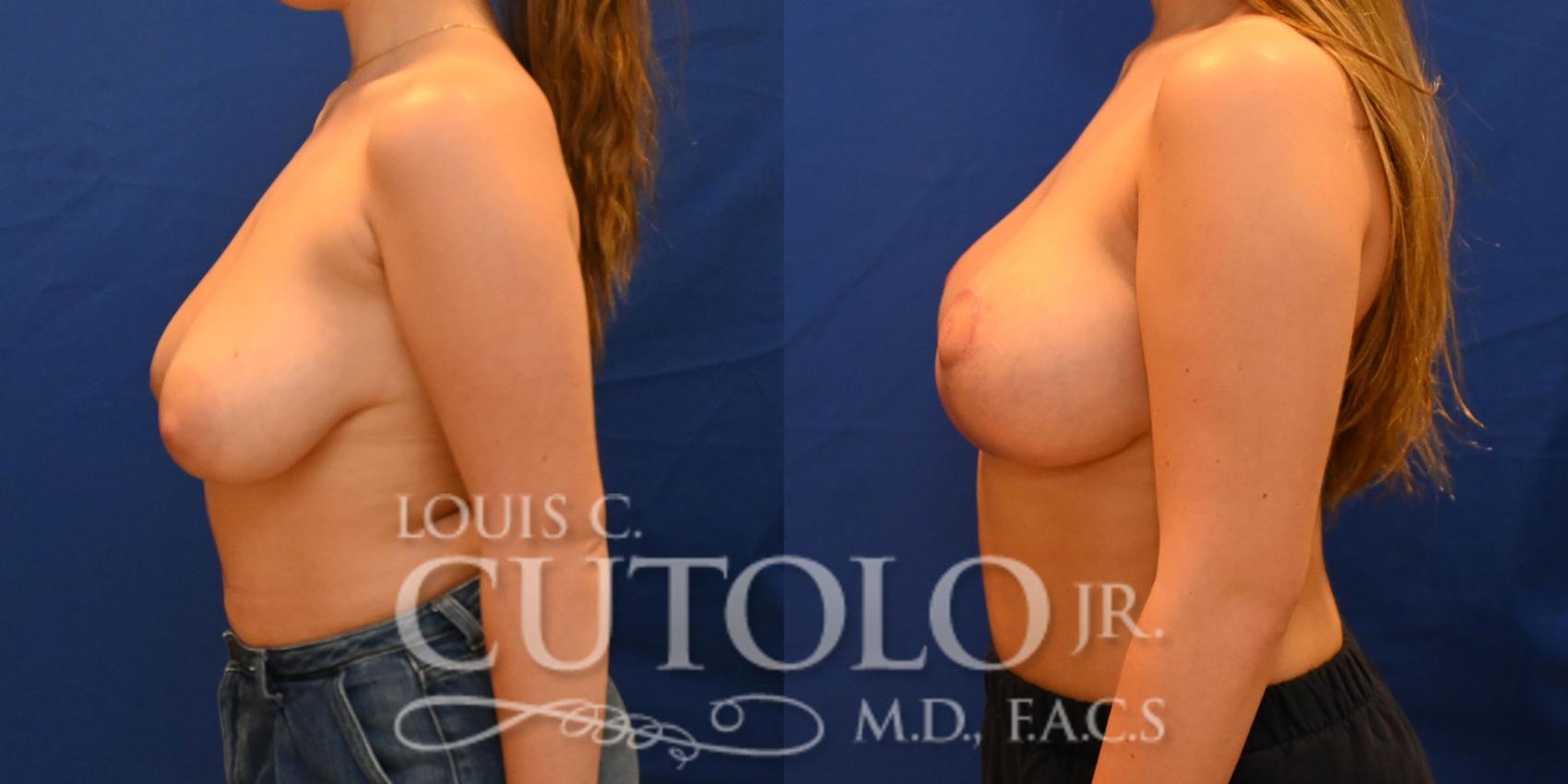 Before & After Breast Lift Case 257 Left Oblique View in Brooklyn, Staten Island, Queens, NY