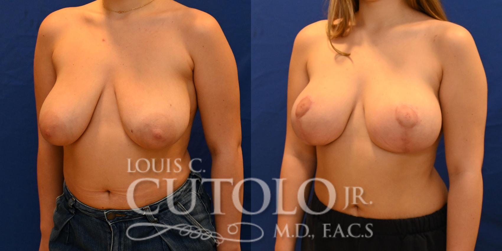Before & After Breast Lift Case 257 Left Side View in Brooklyn, Staten Island, Queens, NY