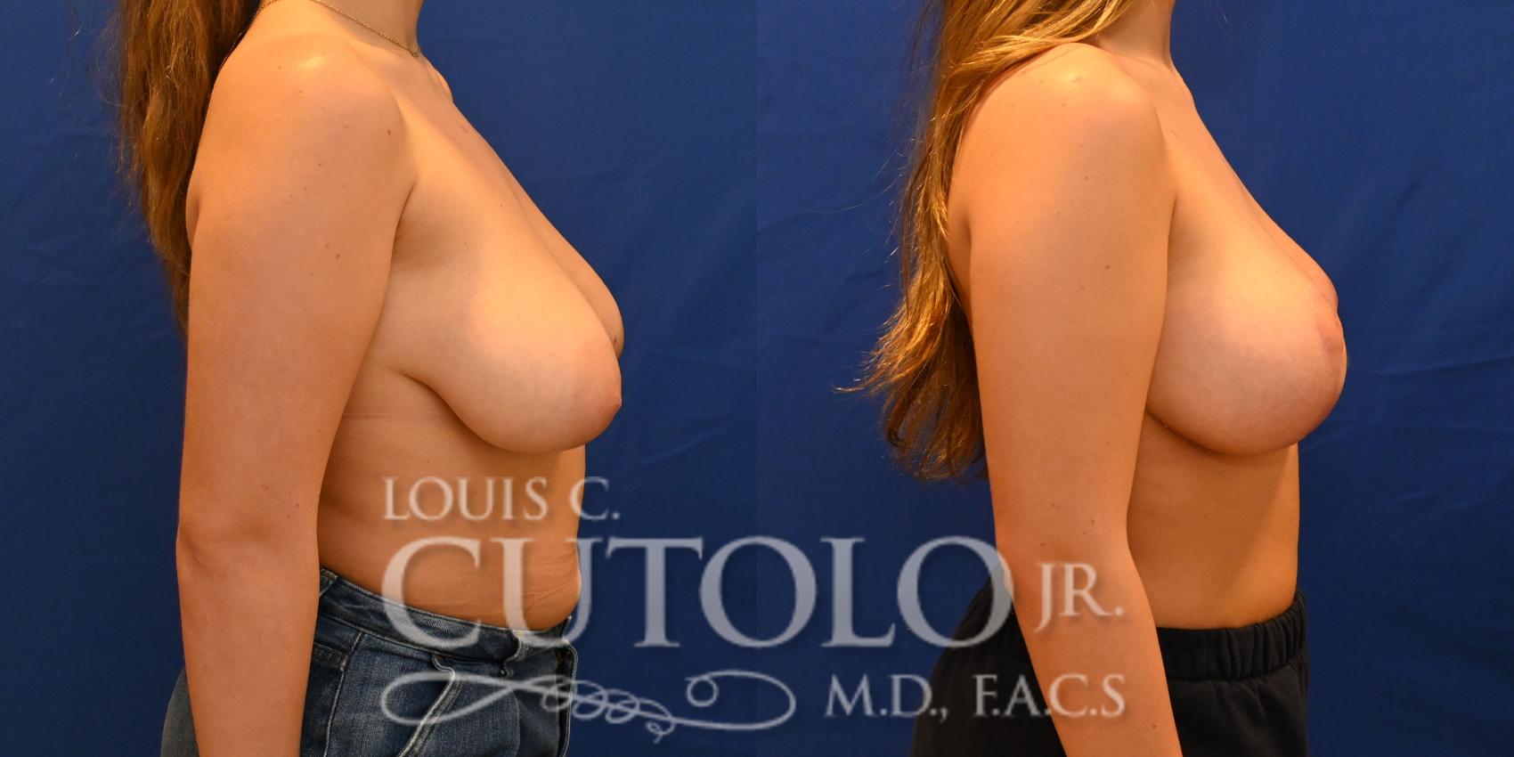 Before & After Breast Lift Case 257 Right Oblique View in Brooklyn, Staten Island, Queens, NY