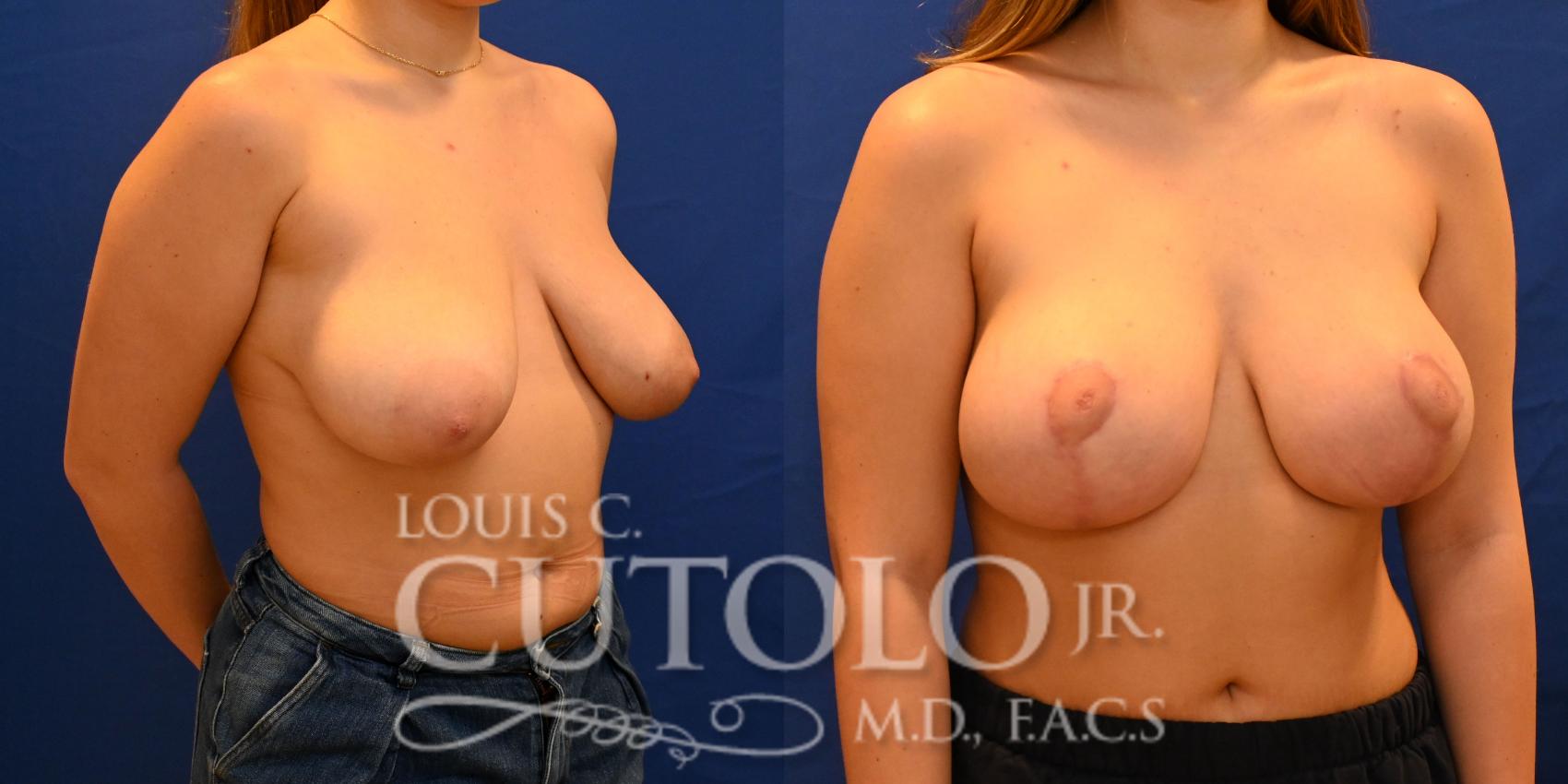 Before & After Breast Lift Case 257 Right Side View in Brooklyn, Staten Island, Queens, NY