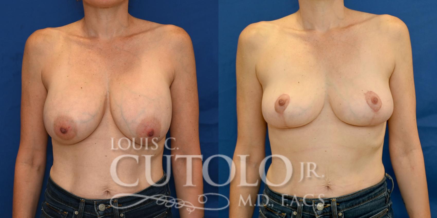 Anterior before