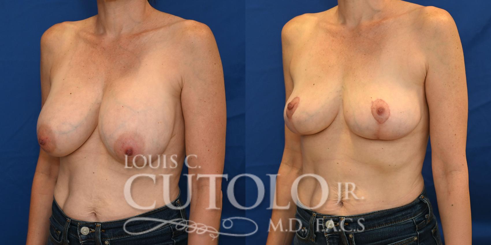 Left Oblique before