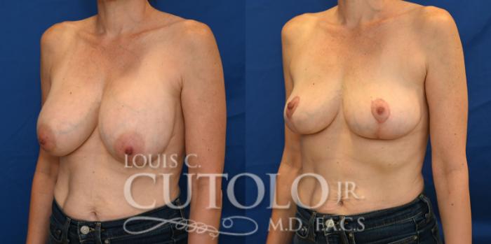 Left Oblique before