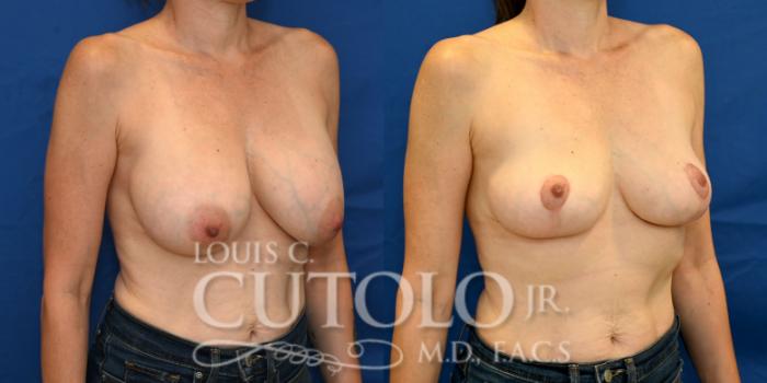 Right Oblique Before