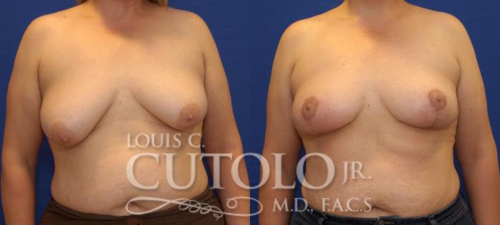 Before & After Breast Lift Case 50 View #1 View in Brooklyn, Staten Island, Queens, NY