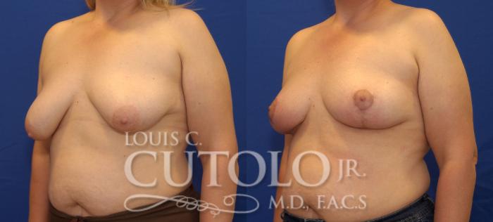Before & After Breast Lift Case 50 View #2 View in Brooklyn, Staten Island, Queens, NY