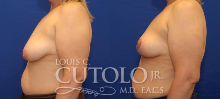 Before & After Breast Lift Case 50 View #3 View in Brooklyn, Staten Island, Queens, NY