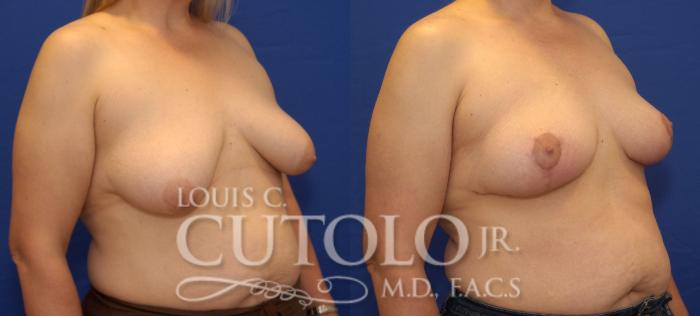 Before & After Breast Lift Case 50 View #4 View in Brooklyn, Staten Island, Queens, NY