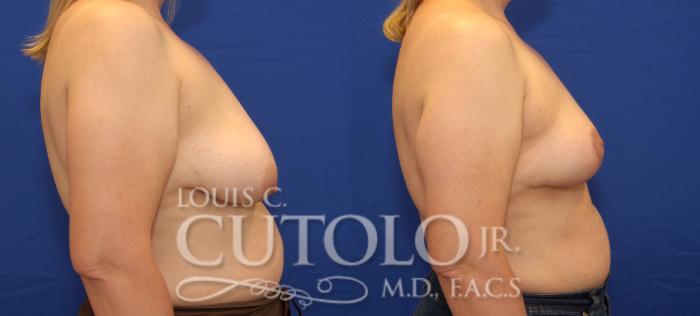 Before & After Breast Lift Case 50 View #5 View in Brooklyn, Staten Island, Queens, NY