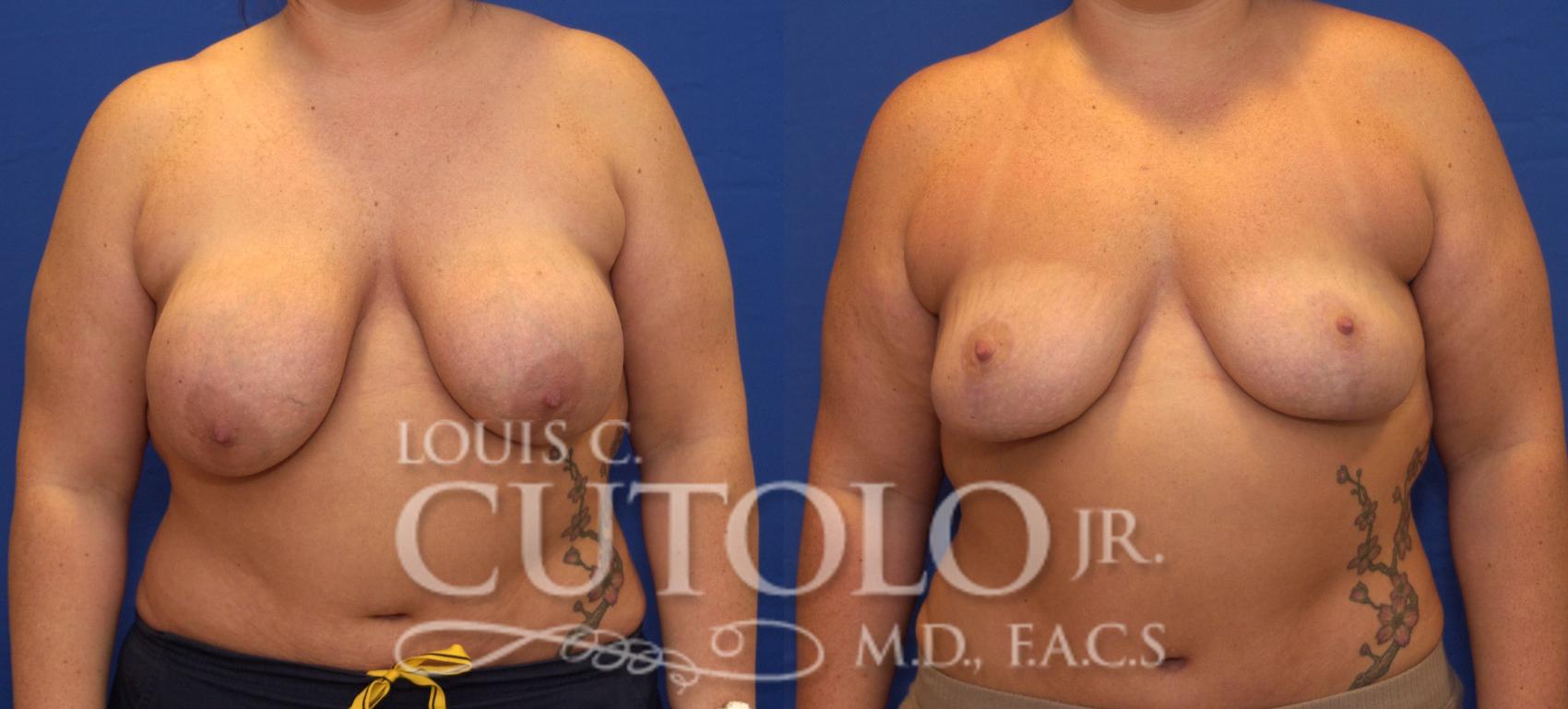 Before & After Breast Lift Case 55 View #1 View in Brooklyn, Staten Island, Queens, NY