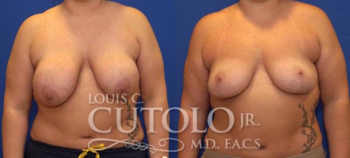 Before & After Breast Lift Case 55 View #1 View in Brooklyn, Staten Island, Queens, NY