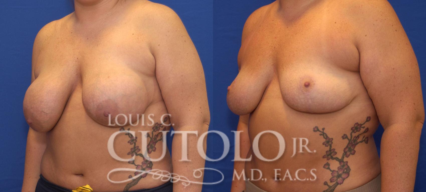 Before & After Breast Lift Case 55 View #2 View in Brooklyn, Staten Island, Queens, NY