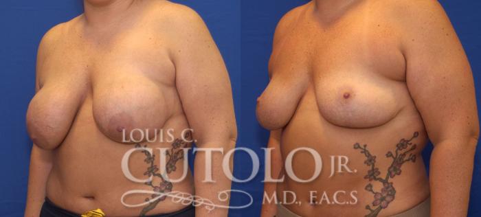 Before & After Breast Lift Case 55 View #2 View in Brooklyn, Staten Island, Queens, NY