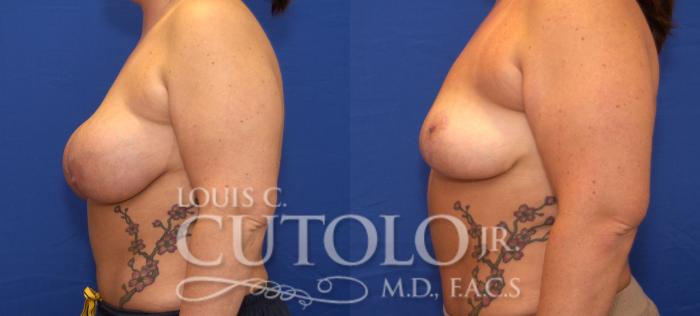Before & After Breast Lift Case 55 View #3 View in Brooklyn, Staten Island, Queens, NY