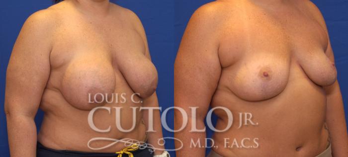 Before & After Breast Lift Case 55 View #4 View in Brooklyn, Staten Island, Queens, NY