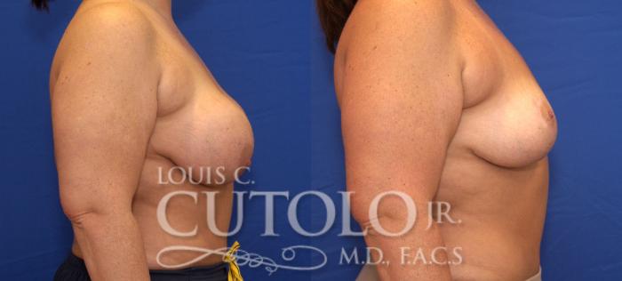 Before & After Breast Lift Case 55 View #5 View in Brooklyn, Staten Island, Queens, NY