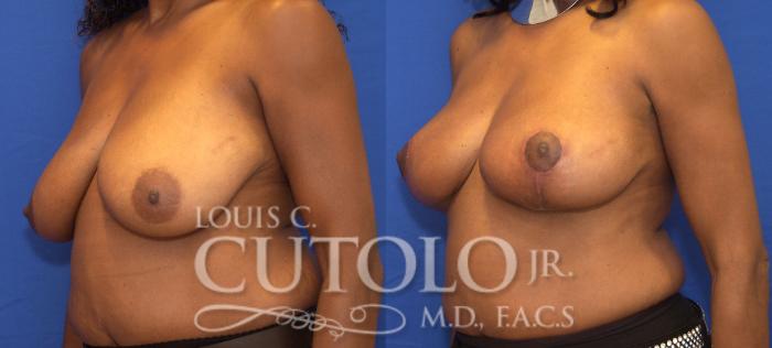 Before & After Breast Lift Case 58 View #2 View in Brooklyn, Staten Island, Queens, NY