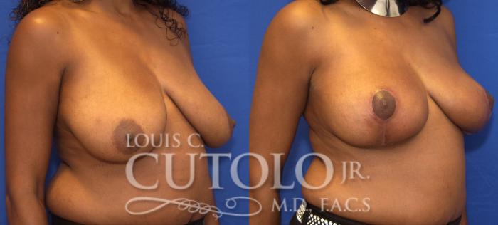 Before & After Breast Lift Case 58 View #4 View in Brooklyn, Staten Island, Queens, NY