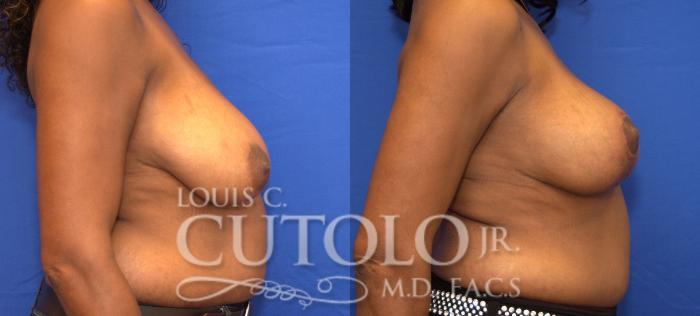 Before & After Breast Lift Case 58 View #5 View in Brooklyn, Staten Island, Queens, NY
