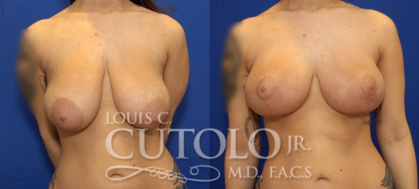 Before & After Breast Lift Case 67 View #1 View in Brooklyn, Staten Island, Queens, NY