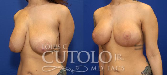 Before & After Breast Lift Case 67 View #2 View in Brooklyn, Staten Island, Queens, NY