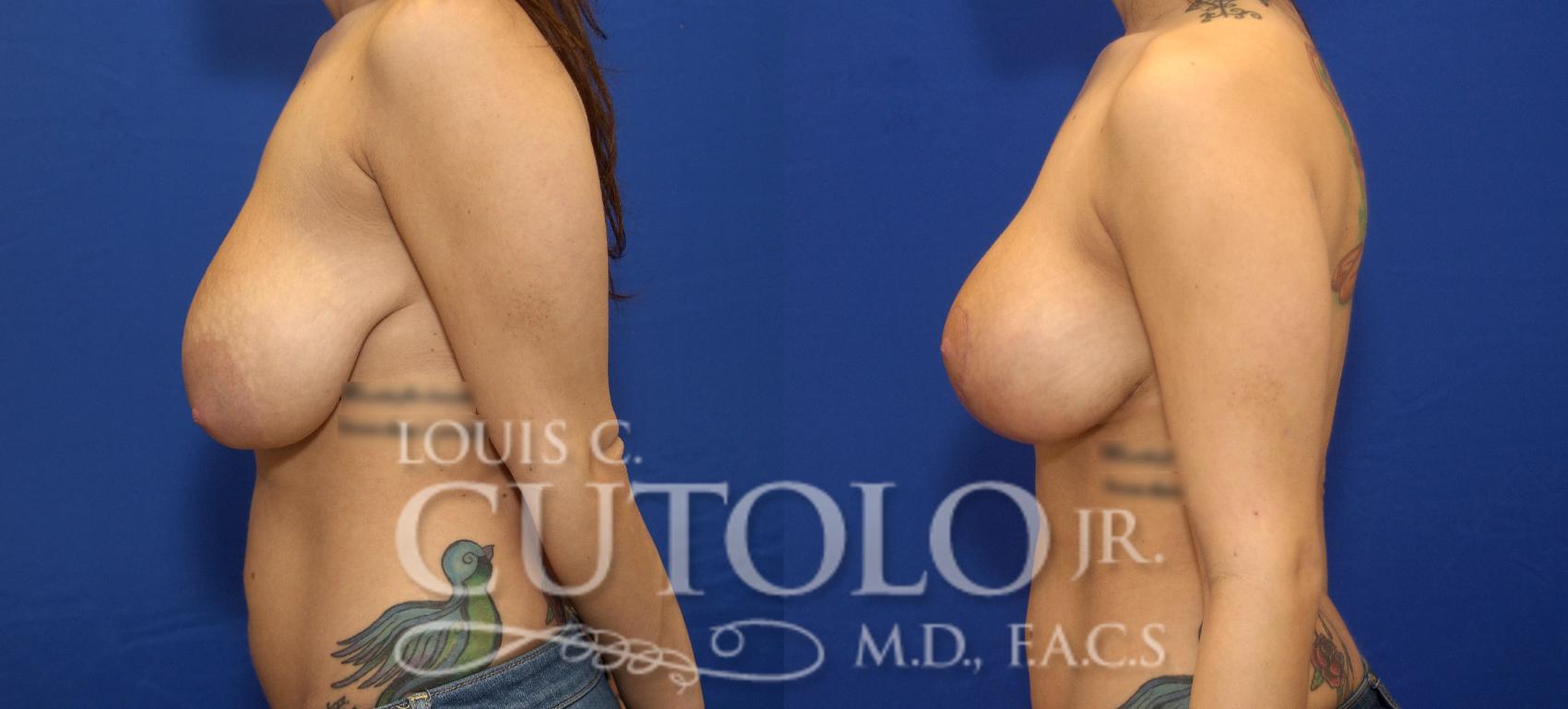 Before & After Breast Lift Case 67 View #3 View in Brooklyn, Staten Island, Queens, NY