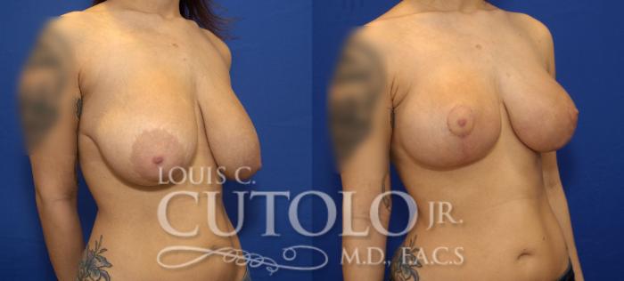 Before & After Breast Lift Case 67 View #4 View in Brooklyn, Staten Island, Queens, NY