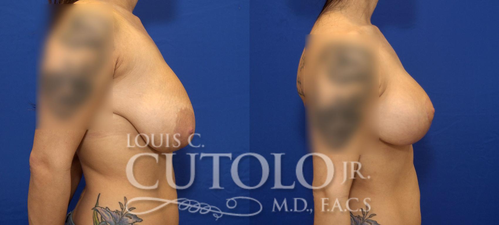 Before & After Breast Lift Case 67 View #5 View in Brooklyn, Staten Island, Queens, NY