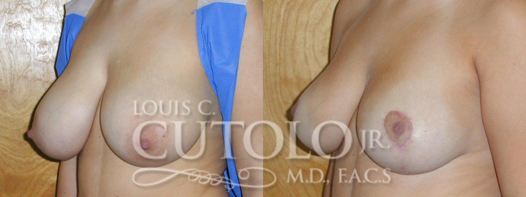 Before & After Breast Reduction Case 10 View #2 View in Brooklyn, Staten Island, Queens, NY