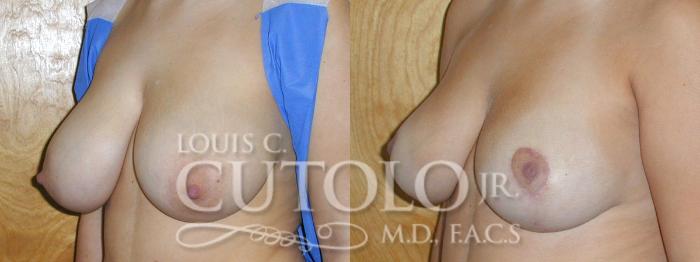 Before & After Breast Reduction Case 10 View #2 View in Brooklyn, Staten Island, Queens, NY