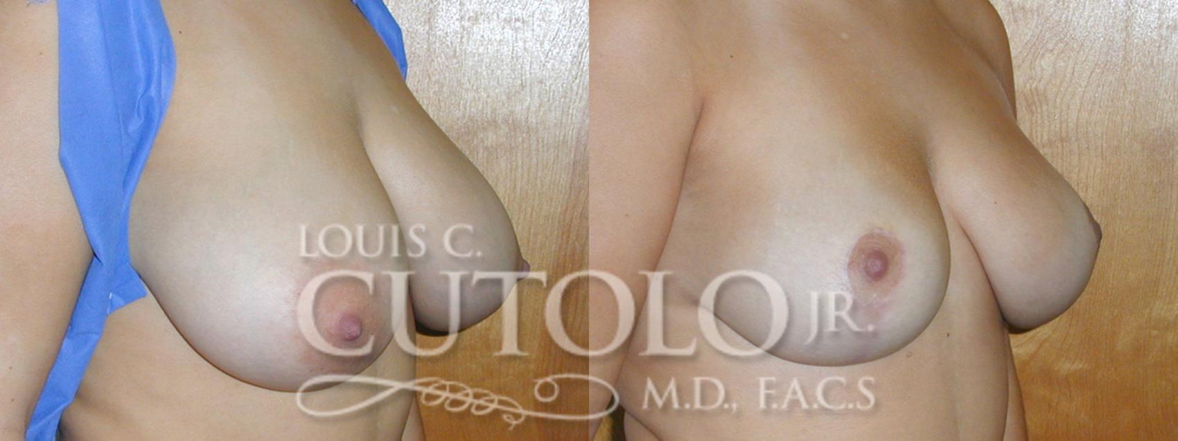 Before & After Breast Reduction Case 10 View #3 View in Brooklyn, Staten Island, Queens, NY