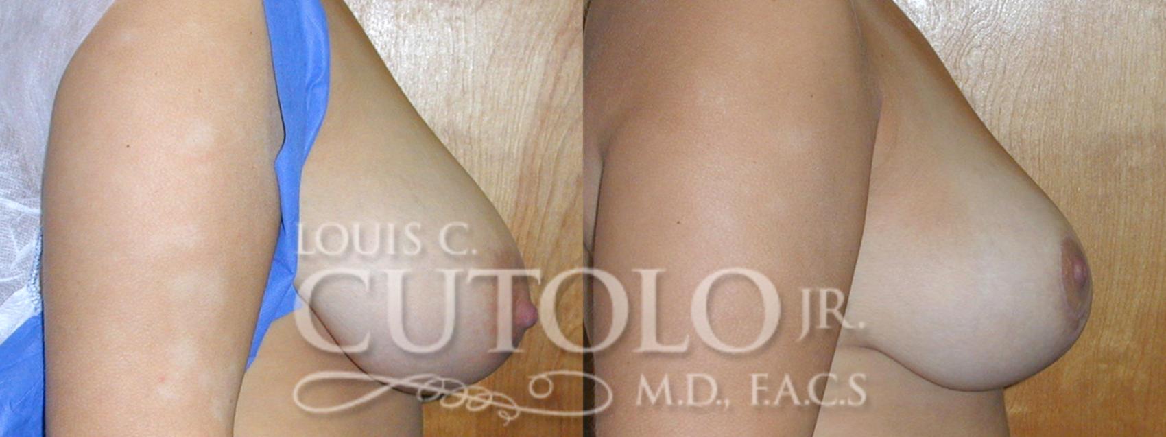 Before & After Breast Reduction Case 10 View #5 View in Brooklyn, Staten Island, Queens, NY
