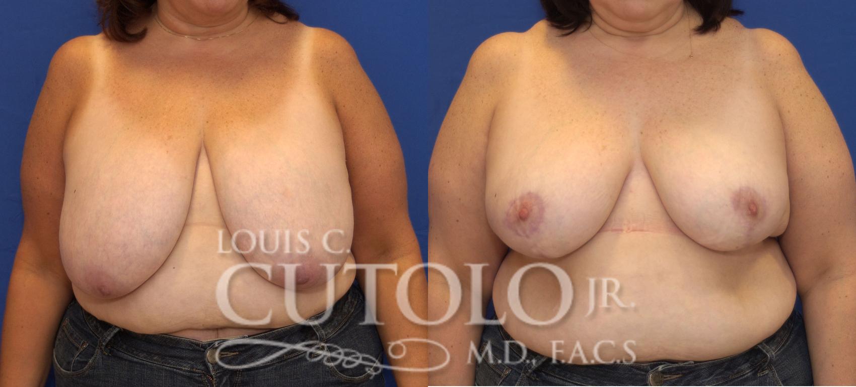 Before & After Breast Reduction Case 112 View #1 View in Brooklyn, Staten Island, Queens, NY