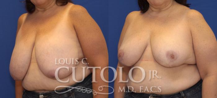 Before & After Breast Reduction Case 112 View #2 View in Brooklyn, Staten Island, Queens, NY