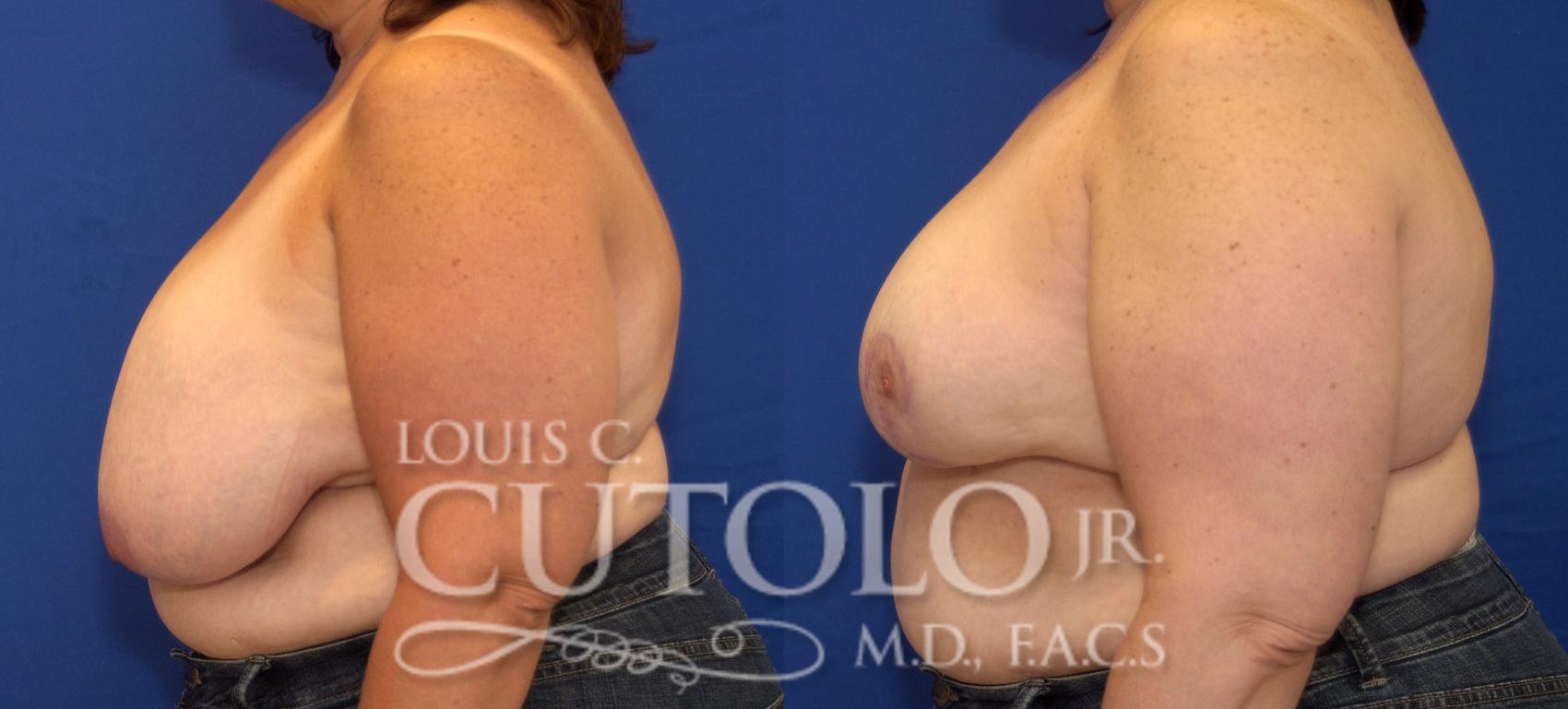 Before & After Breast Reduction Case 112 View #3 View in Brooklyn, Staten Island, Queens, NY