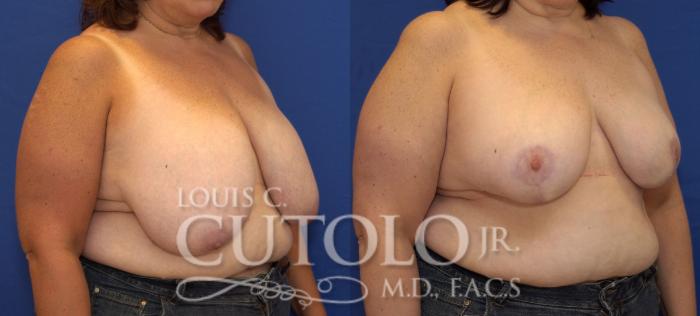 Before & After Breast Reduction Case 112 View #4 View in Brooklyn, Staten Island, Queens, NY
